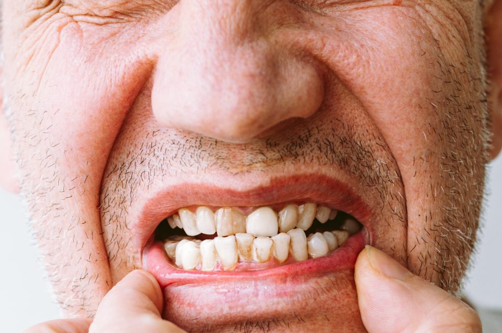 Malattia Parodontale: Riconoscere, Prevenire e Curare - Studio Dentistico Mario Liccardi