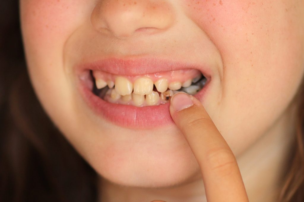 Episodio #2 Laser in Odontoiatria: cura delle carie e piorrea - Blog- Studio Dentistico M. Liccardi a Limena